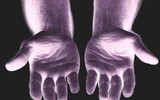 [ẢNH] Giải mã bí ẩn về những người không có dấu vân tay