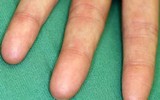 [ẢNH] Giải mã bí ẩn về những người không có dấu vân tay