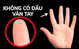 [ẢNH] Giải mã bí ẩn về những người không có dấu vân tay