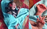 Trẻ sơ sinh có 26 ngón tay chân được tin là hiện thân của nữ thần Ấn Độ
