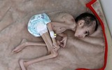 [ẢNH] Xót xa cậu bé Yemen 7 tuổi chỉ nặng có 7kg vì nạn đói