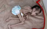 [ẢNH] Xót xa cậu bé Yemen 7 tuổi chỉ nặng có 7kg vì nạn đói