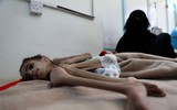 [ẢNH] Xót xa cậu bé Yemen 7 tuổi chỉ nặng có 7kg vì nạn đói