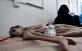 [ẢNH] Xót xa cậu bé Yemen 7 tuổi chỉ nặng có 7kg vì nạn đói