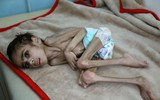 [ẢNH] Xót xa cậu bé Yemen 7 tuổi chỉ nặng có 7kg vì nạn đói
