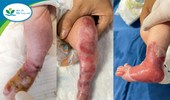 Bé gái sơ sinh mắc bệnh hiếm gặp, từ cẳng chân trở xuống bị trợt loét hết da