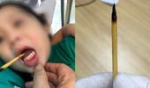 Bé gái 3 tuổi vấp ngã bị chiếc que xiên thịt đâm xuyên qua lưỡi
