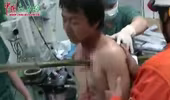 May mắn thoát chết dù bị cọc tre 2m xuyên thấu lồng ngực