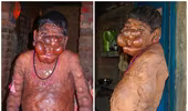 Cậu bé Ấn Độ khốn khổ vì bị hàng trăm khối u nổi trên cơ thể