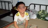 Một bé trai bị bỏng nặng khi đang chơi lồng đèn trung thu