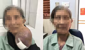 Cụ bà đeo khối u khổng lồ làm biến dạng khuôn mặt nhưng 40 năm mới chịu đi khám lần đầu