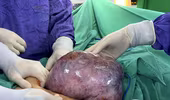 Phát hiện khối u lớn hơn một năm nhưng từ chối phẫu thuật, người phụ nữ nguy kịch
