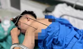 Cứu nam thanh niên 17 tuổi bị cây đinh ba tự chế đâm vào tim
