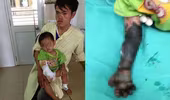 Cháu bé bị hoại tử cánh tay do cha mẹ đắp tro lên vết bỏng