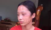 Bênh em gái, nữ sinh cào rách mặt bạn học