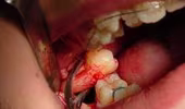 Nhổ sạch răng người yêu sau khi bị “đá”