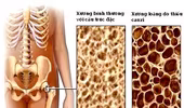 7 cách phòng ngừa loãng xương