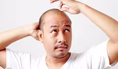 Hói đầu làm tăng nguy cơ bệnh thần kinh nghiêm trọng