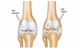 Những điều cần biết về cách chữa trị bệnh thoái hóa khớp