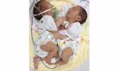 Hai trẻ sơ sinh dính nhau phần bụng