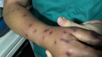 Bị sốc phản vệ độ 3 do ong đốt, người đàn ông được bác sĩ Long Châu cứu nguy trong gang tấc