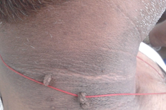 Những dấu hiệu cảnh báo sớm của bệnh tiểu đường