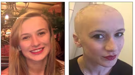 Rụng hết tóc vì quá căng thẳng