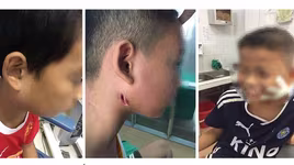 Phát hiện 3 trẻ dương tính với whitmore