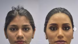 Hình ảnh trước và sau phẫu thuật của Hoa hậu Hoàn vũ Venezuela khiến cư dân mạng dậy sóng