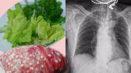 [ẢNH] "Tránh xa" những món ăn tiềm ẩn nhiều nguy cơ mắc bệnh giun, sán