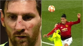 [ẢNH] Sốc với hình ảnh Messi mặt mũi bầm dập sau khi lĩnh đòn của Smalling
