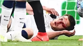 [ẢNH] Rợn người hình ảnh sao Tottenham nằm sân với khuôn mặt đầm đìa máu