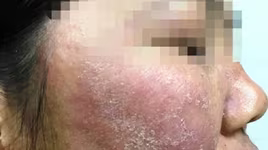 Mặt nữ nhân viên khách sạn 20 tuổi lở loét, mọc đầy lông vì trị trứng cá