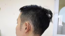 Thanh niên 9x bị rách màng nhĩ vì điện thoại mới mua phát nổ lúc nửa đêm