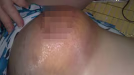 "Vòng 1" sập sệ sau sinh, mẹ bỉm sữa trả giá đắt vì "đại tu" ở thẫm mỹ viện tư