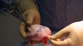 Đối tượng mua, bán thận có thể bị tù chung thân