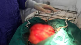 Một người ở Hà Nội mắc ung thư hiếm gặp, cắt bỏ 2 lần lại tái phát u “khủng”