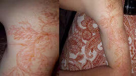 [ẢNH] Bí ẩn hiện tượng "hoa sét" xuất hiện trên cơ thể sau khi bị sét đánh trúng