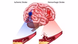 Thói quen giúp người trẻ tránh xa đột quỵ