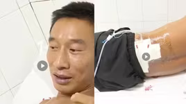 Bị sét đánh 2 lần trong 5 phút, người đàn ông sống sót thần kỳ