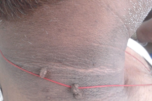 Những dấu hiệu cảnh báo sớm của bệnh tiểu đường