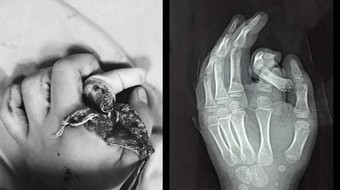 Hà Nội: Đưa tay vào máy giặt đang chạy, bé trai 6 tuổi bị tai nạn nghiêm trọng