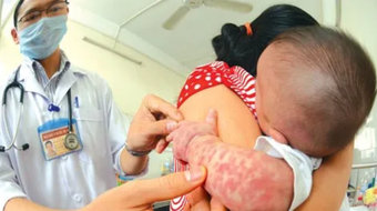 Hà Nội có ca mắc sởi và viêm não Nhật Bản thứ hai trong năm 2024