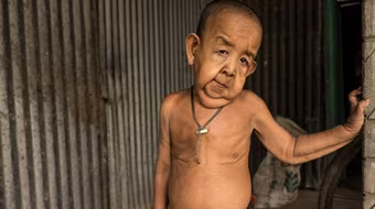 Cha mẹ bất lực nhìn con trai 4 tuổi già như ông cụ 80 tuổi 