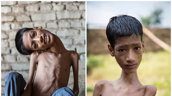 Cuộc sống thay đổi của cậu bé cổ lệch từng gây sốc cả thế giới