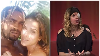 Số phận đau lòng của người đẹp thi hoa hậu bị bạn trai ghen tuông tạt axit