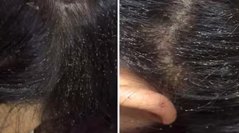 Nổi da gà xem chấy bò lổm ngổm đầy đầu bé gái