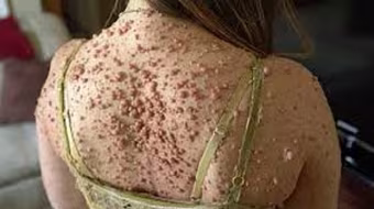 Chi chít gần 6.000 nốt mụn thịt khắp người