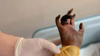 Bé gái bỏng 80% cơ thể vì cứu bố