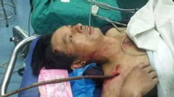 Sống sót dù thanh sắt xuyên qua ngực